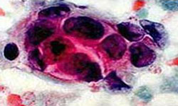 ماموگرافی عامل تشخیص زود هنگام سرطان سینه